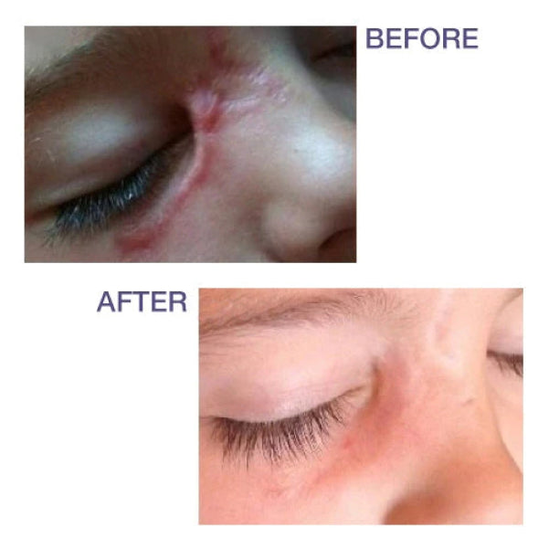 Pro-Sil Narbenstift mit Sonnenschutzfaktor